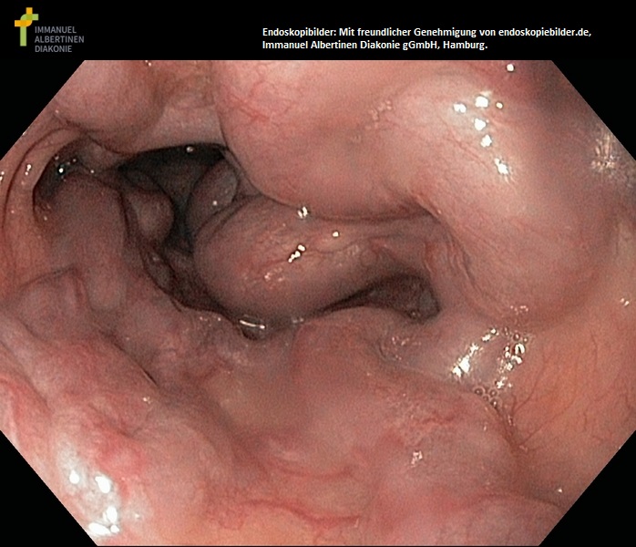 Ösophagusvarizen_Grad_IV.jpg