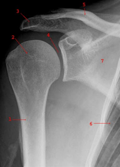 Normales Frontalbild der rechten Schulter 1 = Humerus 2 = Caput humeri 3 = Acromion 4 = Gelenkspalt 5 = Clavicula 6 = Costa 7 = Scapula