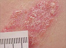 Die primären Hautveränderungen bei einer Psoriasis sind scharf begrenzte, erythematöse Plaques, die mit dicken, weißen oder silbrig glänzenden, stearinartigen, teilweise festsitzenden Schuppen bedeckt sind.