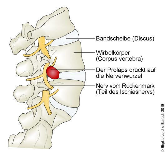 Lumbaler Bandscheibenvorfall: von der Seite