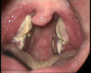 Mononucleosis1.jpg