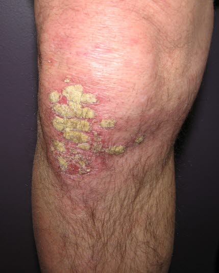 Vor allem werden die Extensorseiten von Psoriasis befallen. Knie, Ellenboden und Kopfhaut sind die üblichsten Lokalisationen.