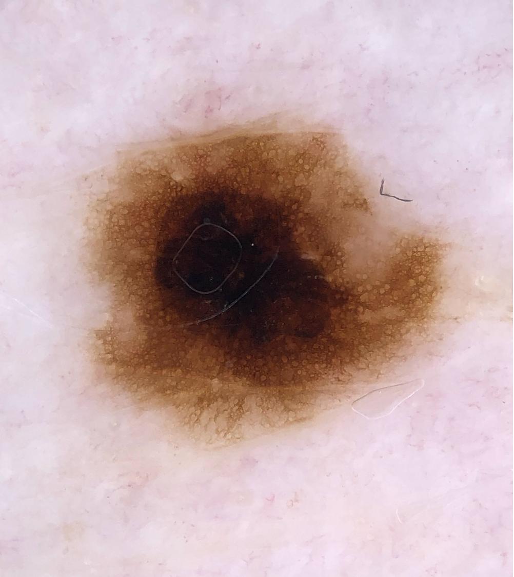 Blotch - Typisk - Junction Nevus med Hyperpigmentering Centralt.png