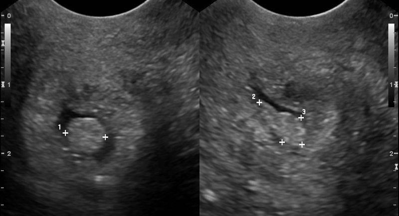 800px-Cervical_polyp.jpg