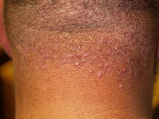 Folliculitis keloidalis 