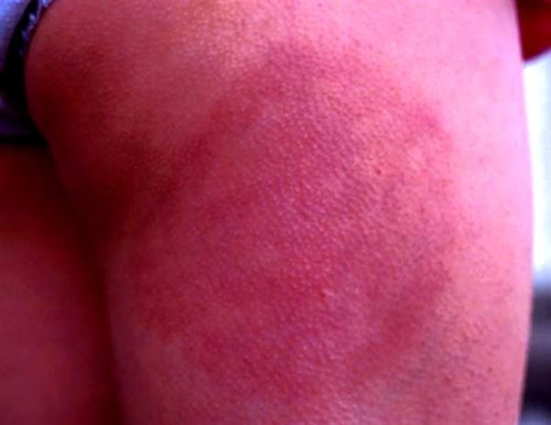 244-2-erythema-migrans.jpg