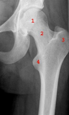 Frontalbild der linken Hüfte: 1 = Caput femoris (Gelenkkopf) 2 = Collum femoris (Oberschenkelhals) 3 = Trochanter major 4 = Trochanter minor