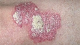 4963-2-psoriasis-plakk (2).jpg