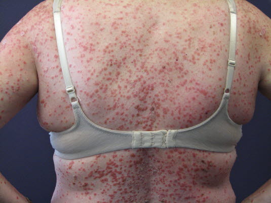 Psoriasis guttata bricht häufig nach einer Infektion der oberen Atemwege aus. Die Variante ist durch weit verbreitete, erythematöse, kleine, schuppende Papeln an Rumpf, Armen und Beinen gekennzeichnet.