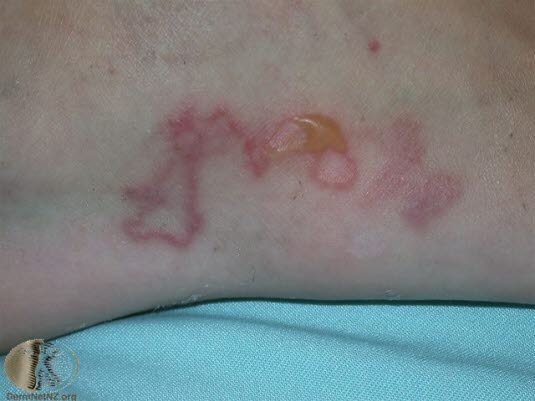 Ankylostomiasis