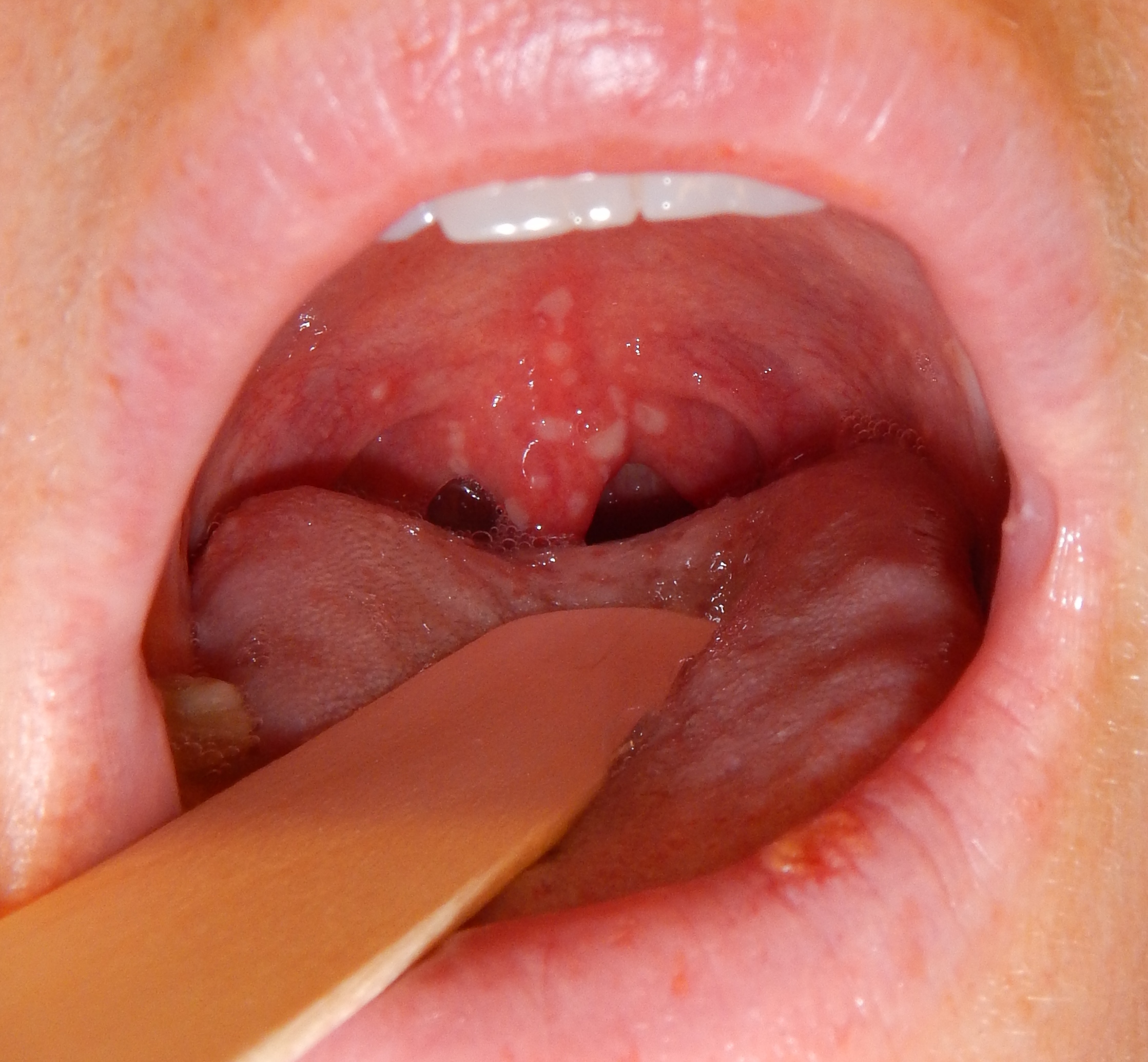 Herpangina2016