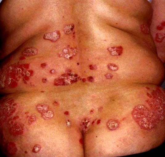 Typisches Aussehen bei Psoriasis vulgaris. Das Bild zeigt multiple gut definierte, erythematöse Plaques mit unterschiedlichem Grad der Infiltration und Schuppenbildung.