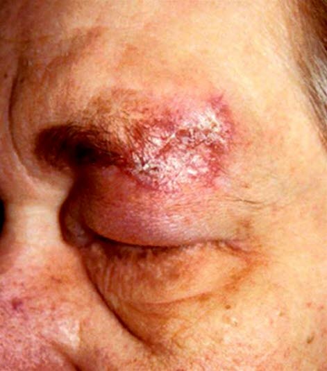 Diskoider Lupus erythematodes: scharf abgegrenzte, erythematöse, schuppende Plaques im Gesicht. Im Verlauf entwickeln sich atrophe Narben.