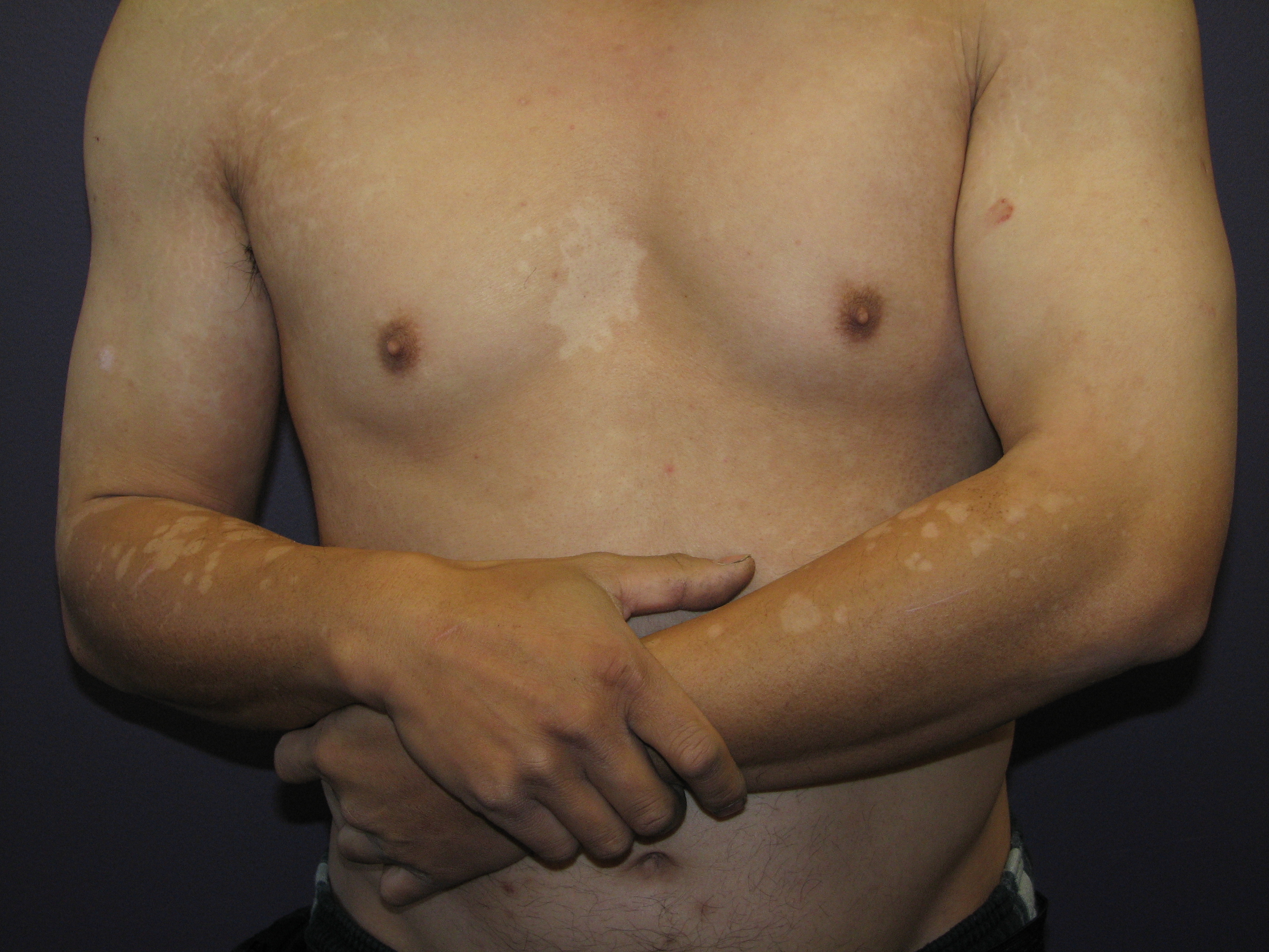 Pityriasis versicolor, hypopigmentert IKKE BRUK.jpg