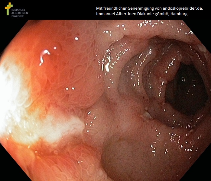 Eitrige Divertikulitis.jpg