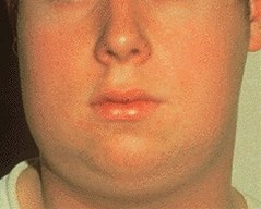 Vergrößerte Halslymphknoten bei Mumps Mumps-2.0.jpg