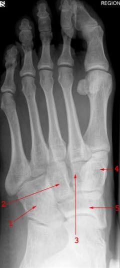 Fuß, normal, schräg: 1 = Os cuboideum (Würfelbein) 2 = Os cuneiforme laterale (laterales Keilbein) 3 = Os cuneiforme intermedium (intermediäres Keilbein) 4 = Os cuneiforme mediale (mediales Keilbein) 5 = Os naviculare (Kahnbein)