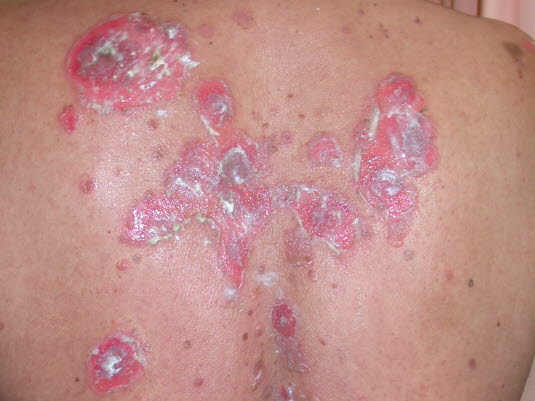 Pemphigus vulgaris