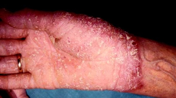Ppp Psoriasis Bilder () Ppp Psoriasis Bilder