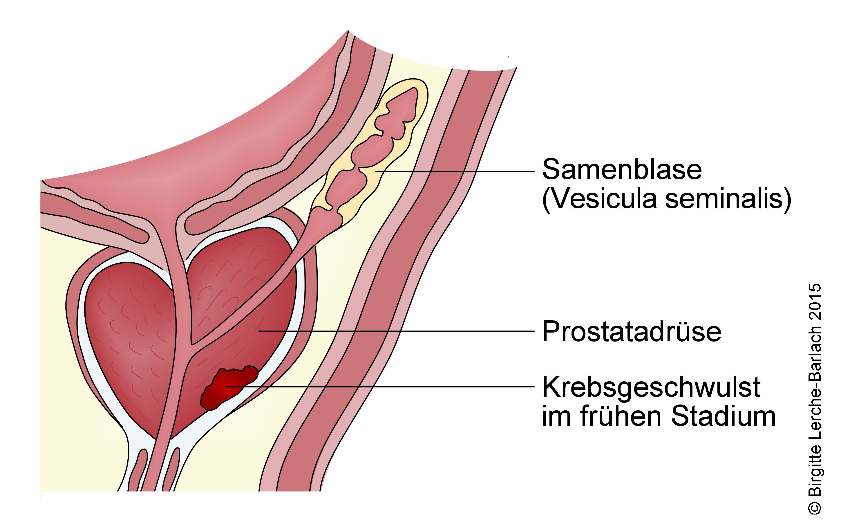 Prostatakrebs schmerzen Prostatakrebs schmerzen