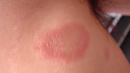 Roschenflechte Pityriasis Rosea Deximed