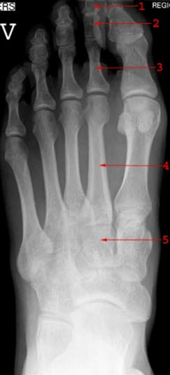 Normale Frontalansicht: 1 = Distale Phalanx 2 = Mediale Phalanx 3 = Proximale Phalanx 4 = Metatarsus 5 = Intermediäres Keilbein