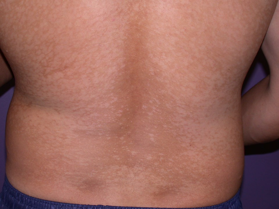 47398-2-pityriasis-versicolor.jpg