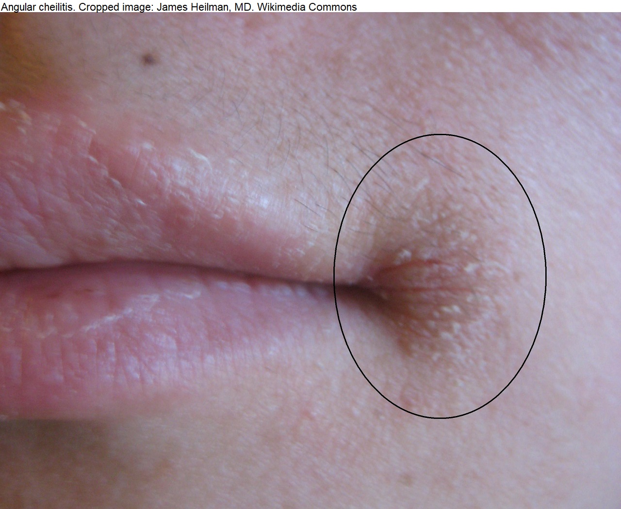 1024px-Angular_Cheilitis.jfif