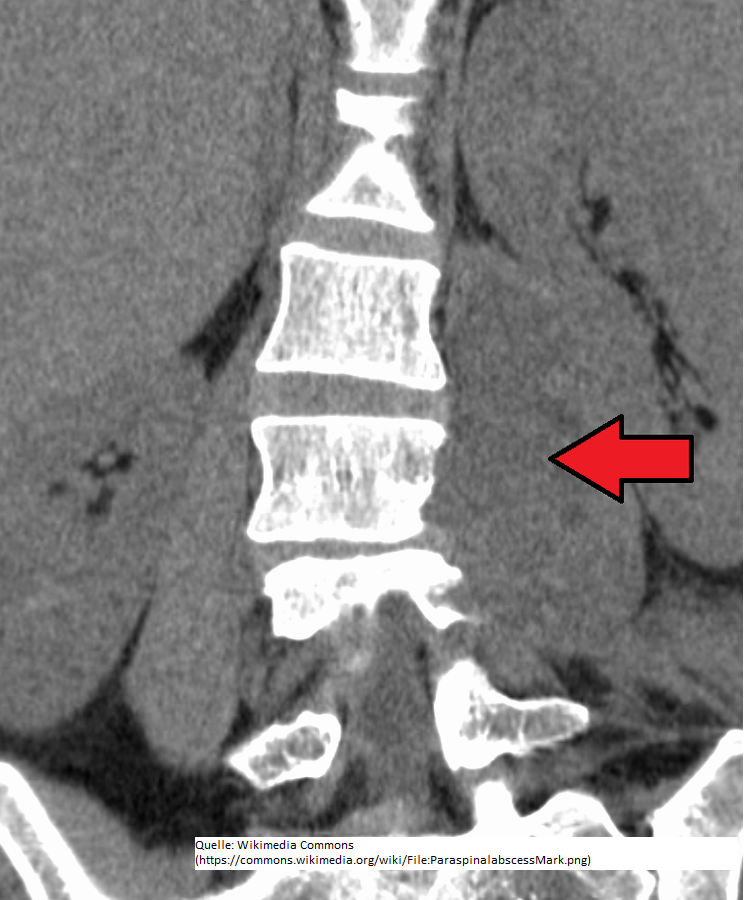 Paraspinaler Psoasabszess (CT).png