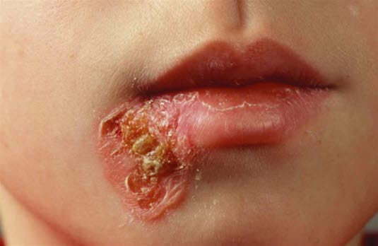 Impetigo contagiosa