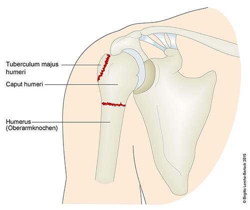 Fraktur des proximalen Humerus