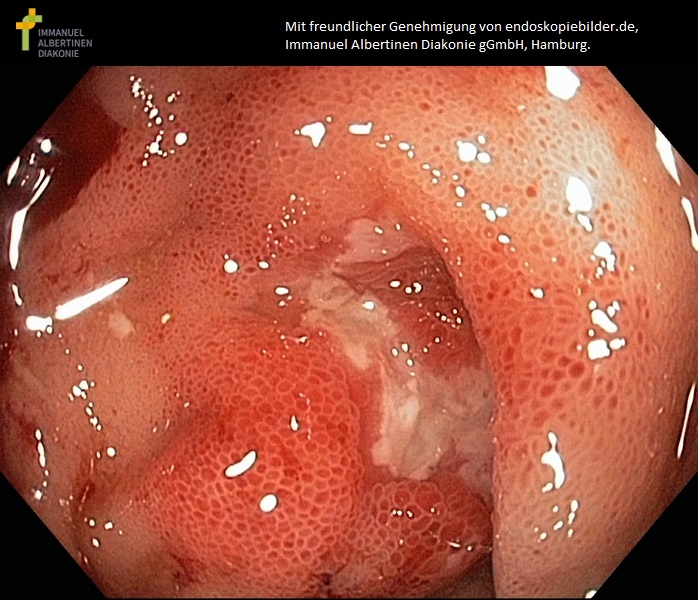 Ileitis terminalis_ Morbus Crohn.jpg