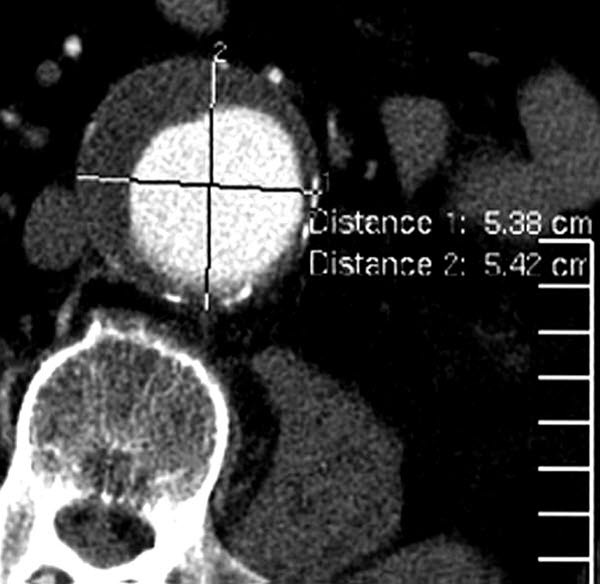 Aortenaneurysma Deximed Deutsche Experteninformation Medizin