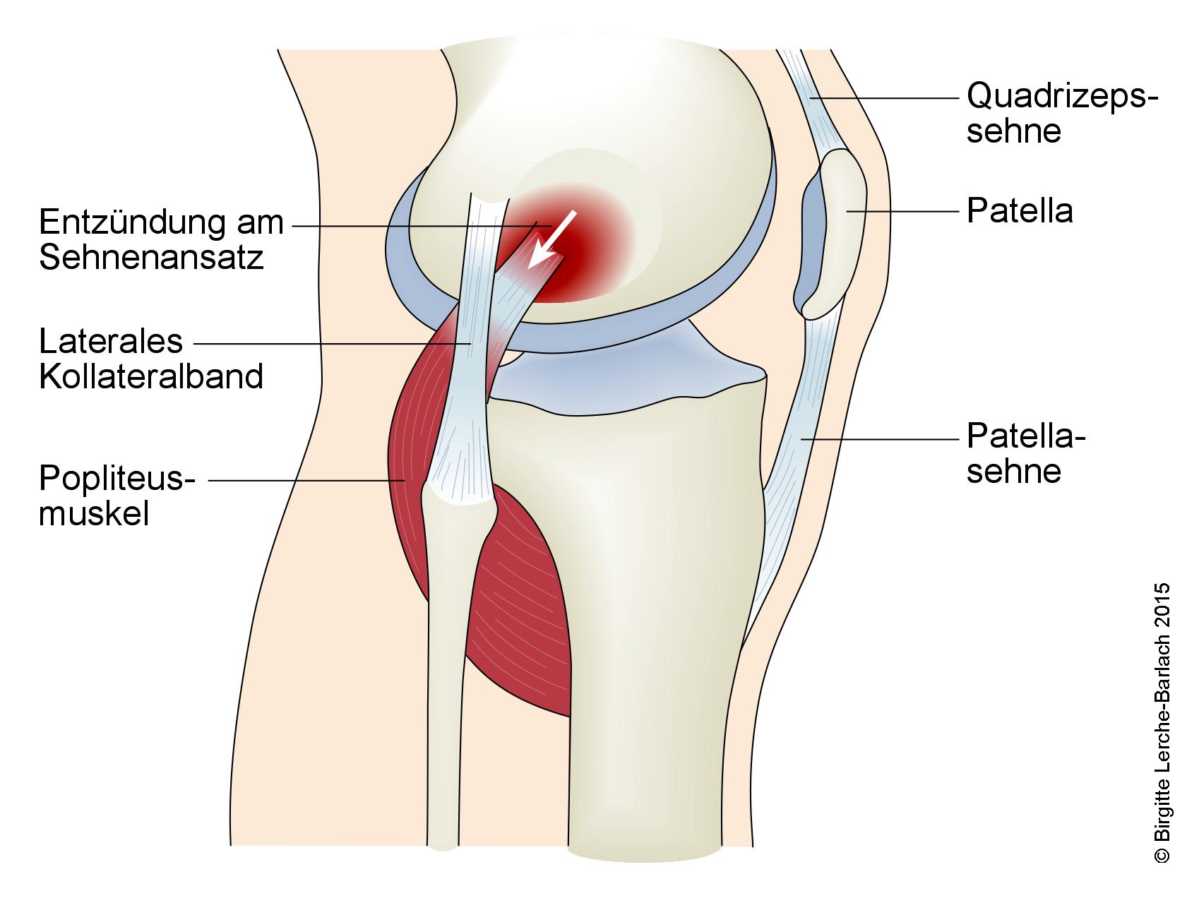 Popliteus Injection TeamPraxis | Tendopathie des Musculus popliteus