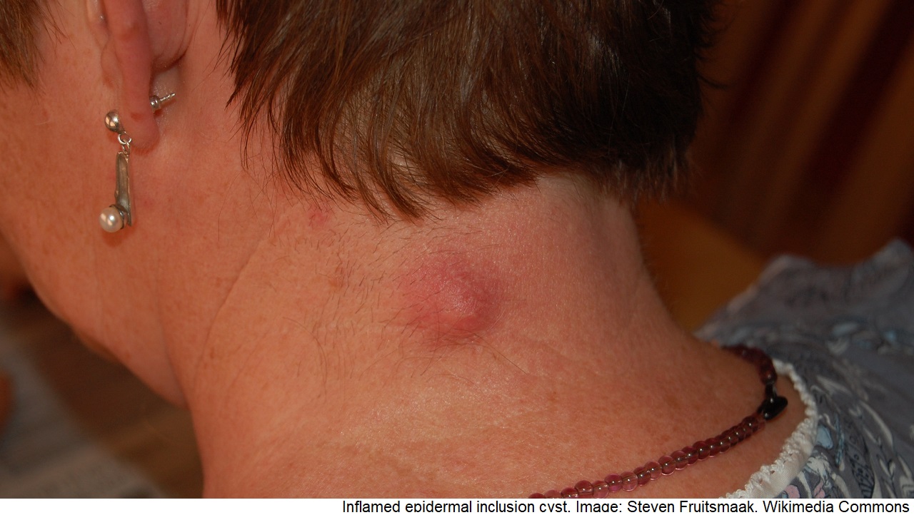 Inflamed_epidermal_inclusion_cyst.jpg