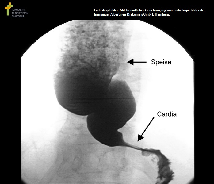 Achalasie mit sichtbarer Dilatation im Röntgen.jpg