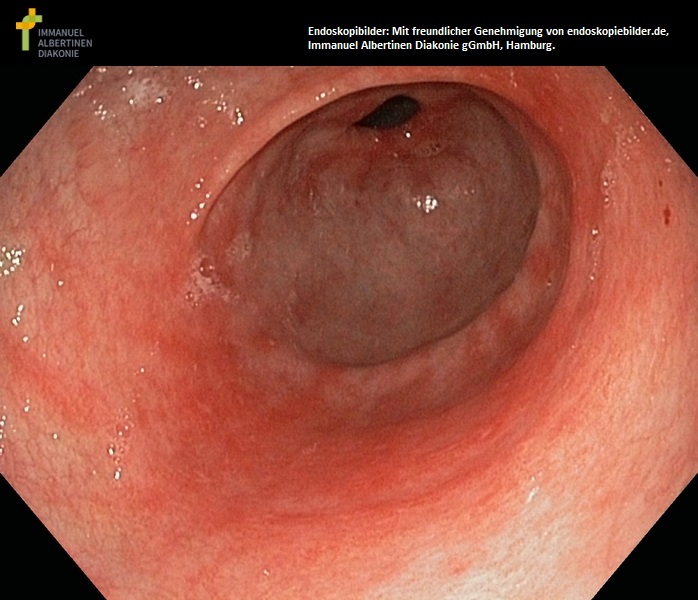 Antrum mit Schleimhautatrophie, atrophische Gastritis.jpg