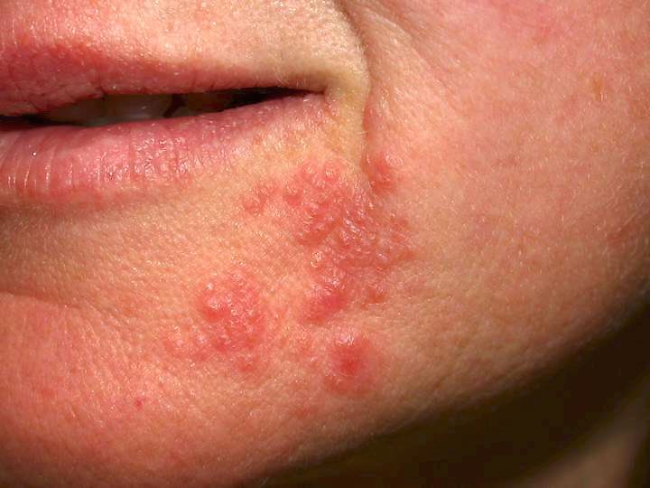 e-zigarette ausschlag im gesicht Periorale Dermatitis (Ausschlag um den Mund)
