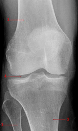 Normales Frontalbild des rechten Knies: 1 = Femur 2 = Tibia 3 = Fibula 4 = Gelenkspalte