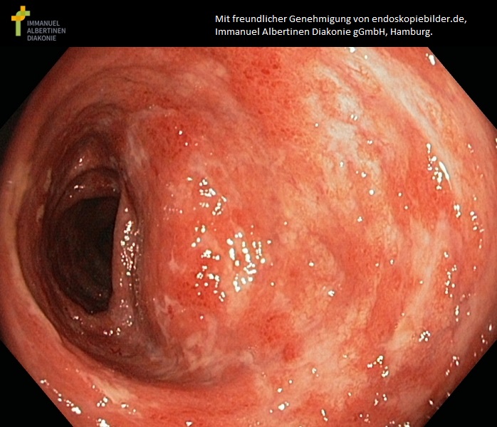 Colitis ulcerosa mit mittlerer Aktivität.jpg