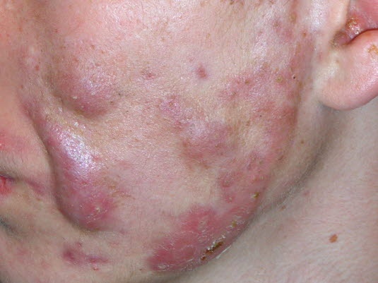 Acne cystica