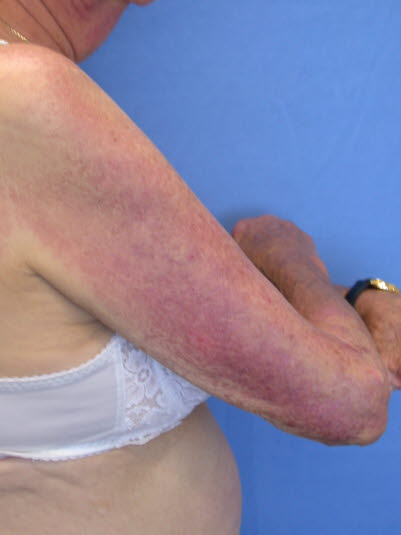 Primärläsion mit Dermatomyositis: blau-violettfarbenes, makuläres Erythem mit symmetrischer Verteilung Muskelkater bei Palpation