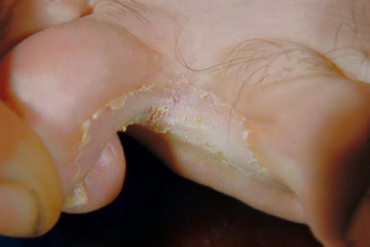 Tinea pedis