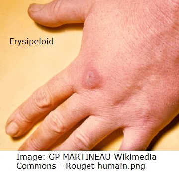 erysipeloid 2.jpg