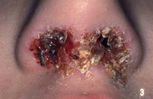 Impetigo contagiosa: mit Staphylokokken infizierte Läsion in der Nasenöffnung