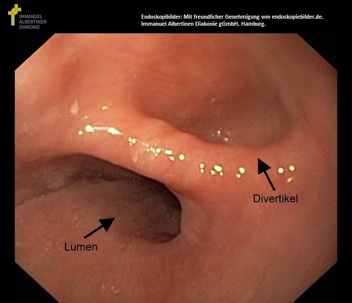 Ösophagusdivertikel.jpg