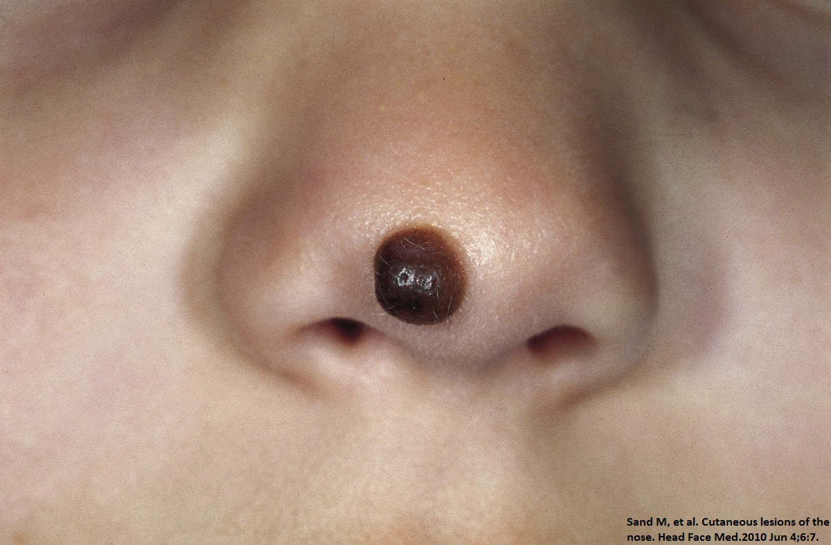 Congenital_melanocytic_nevus_01.jpg