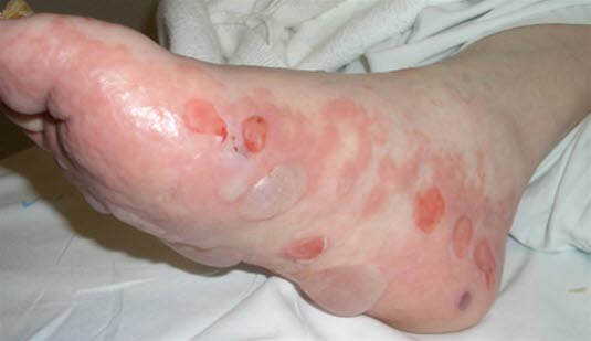 Bullöses Pemphigoid 3