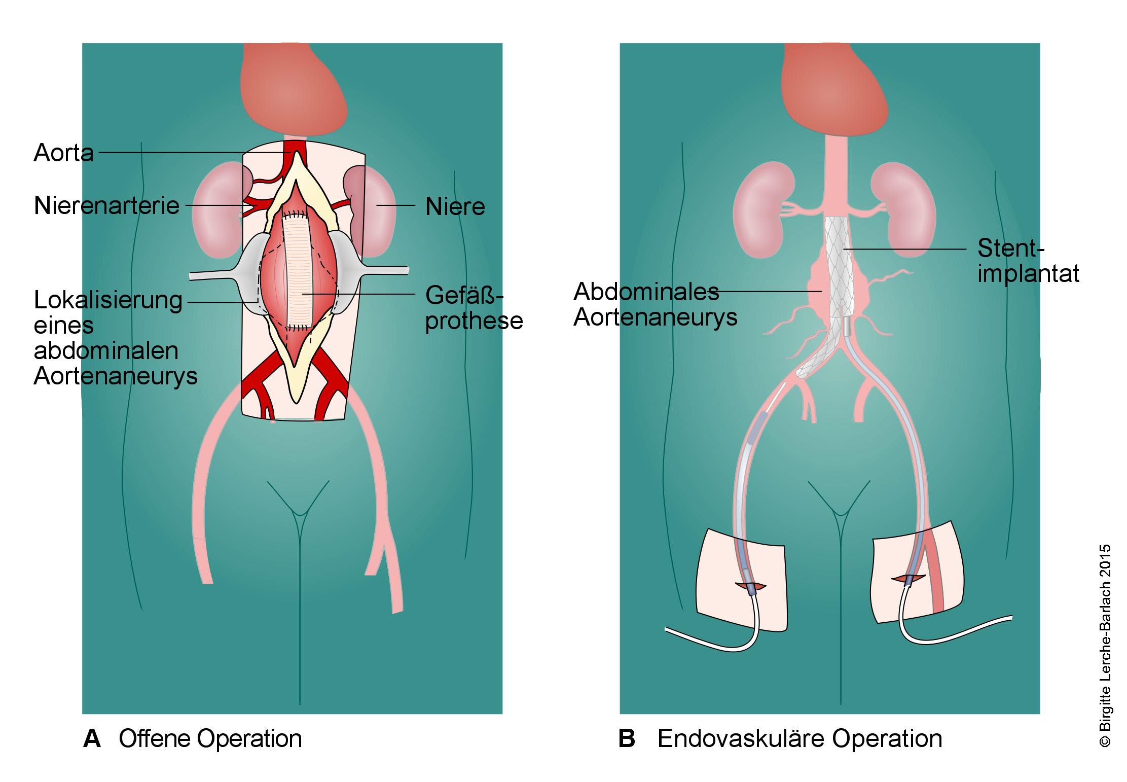 Aortenaneurysma Deximed Deutsche Experteninformation Medizin