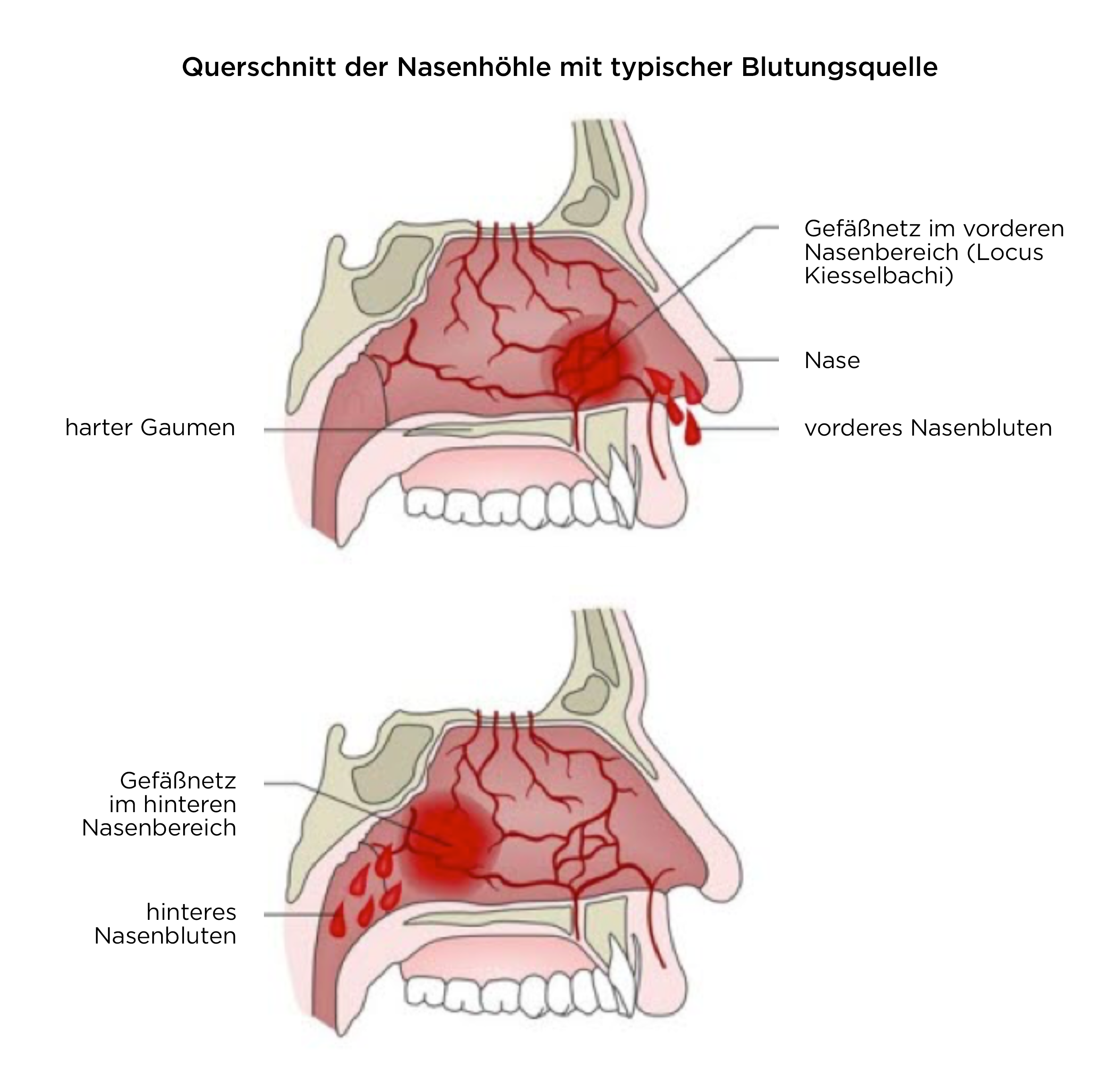 kann man vom vapen nasenbluten bekommen Epistaxis (Nasenbluten)